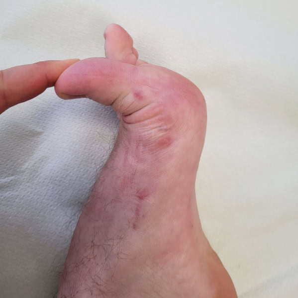 Stopa po operacji małoinwazyjnej palucha koślawego met. MICA - zdjęcie