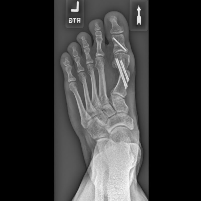 Stopa po operacji małoinwazyjnej palucha koślawego met. MICA -rtg