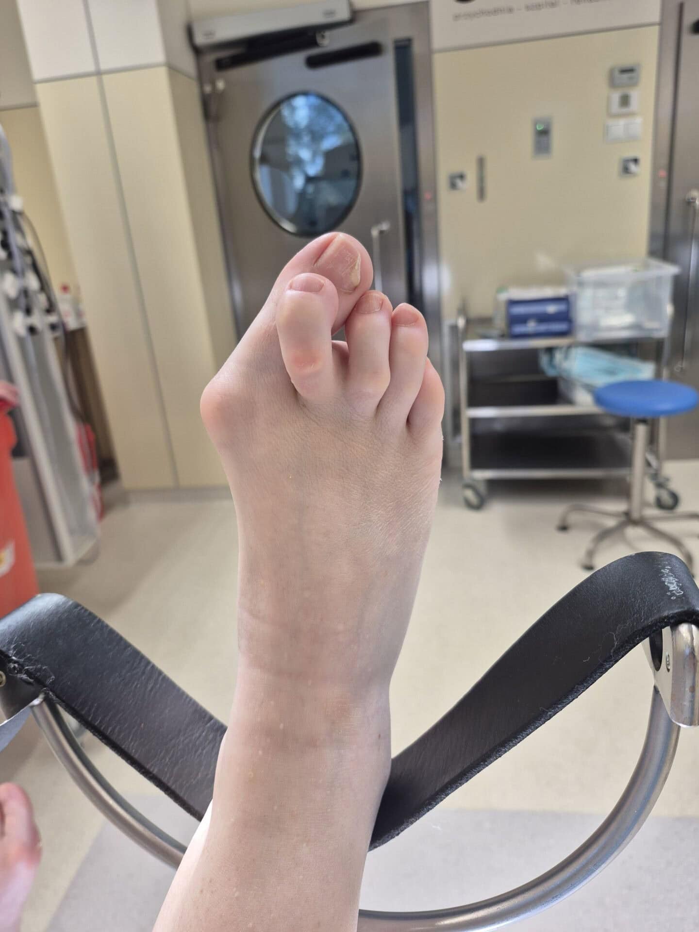 Palec młotkowaty stopy - zdjęcie z bloku operacyjnego