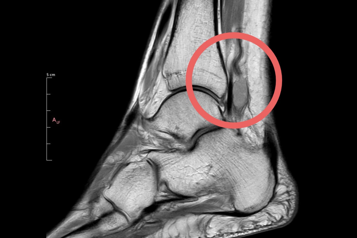 zespoł ciesni kanału stepu, mri